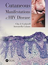 CUTANEOUS MANIFESTATIONS OF HIV DISEASE (HB) 